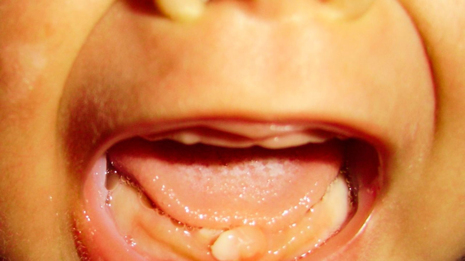 Risk Factors and Who Is More