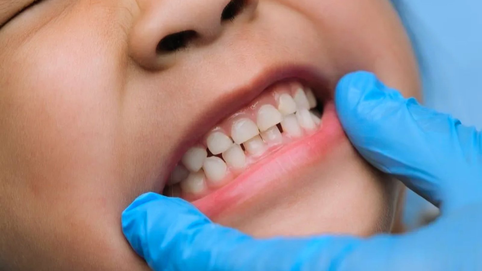 Signs Your Child Is Losing Teeth