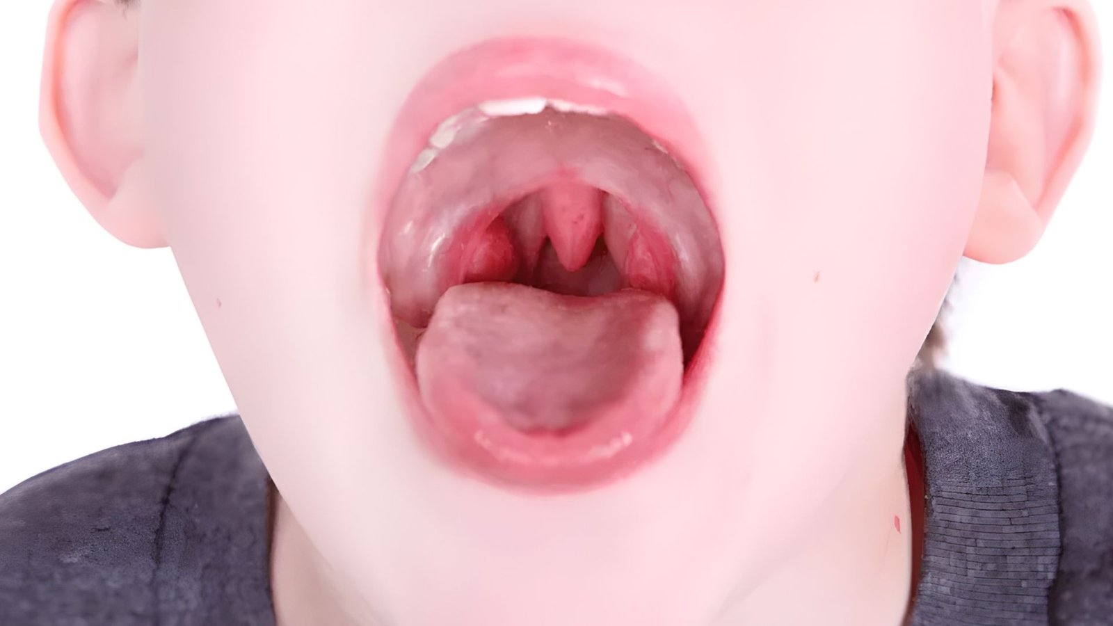 Tonsil Stones