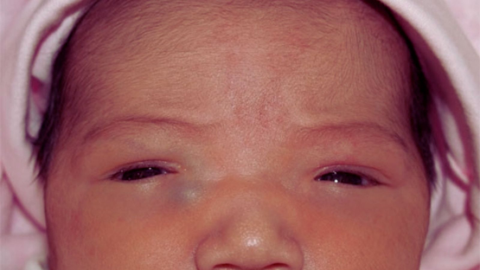 Is It Normal for a Baby to Wake Up With a Swollen Eye?