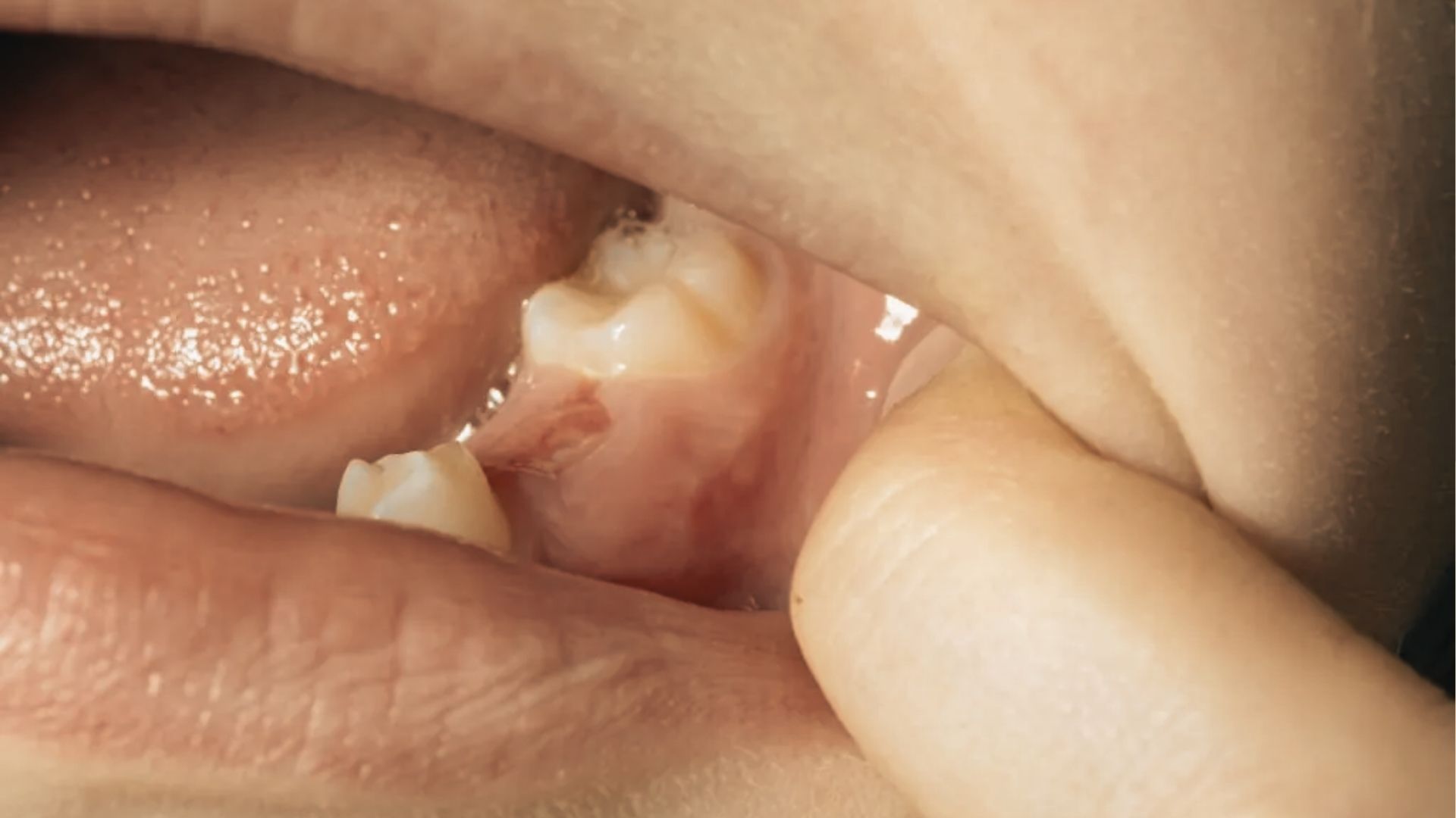 Extreme close-up of a baby’s gums with a molar tooth breaking through and slight gum swelling visible.