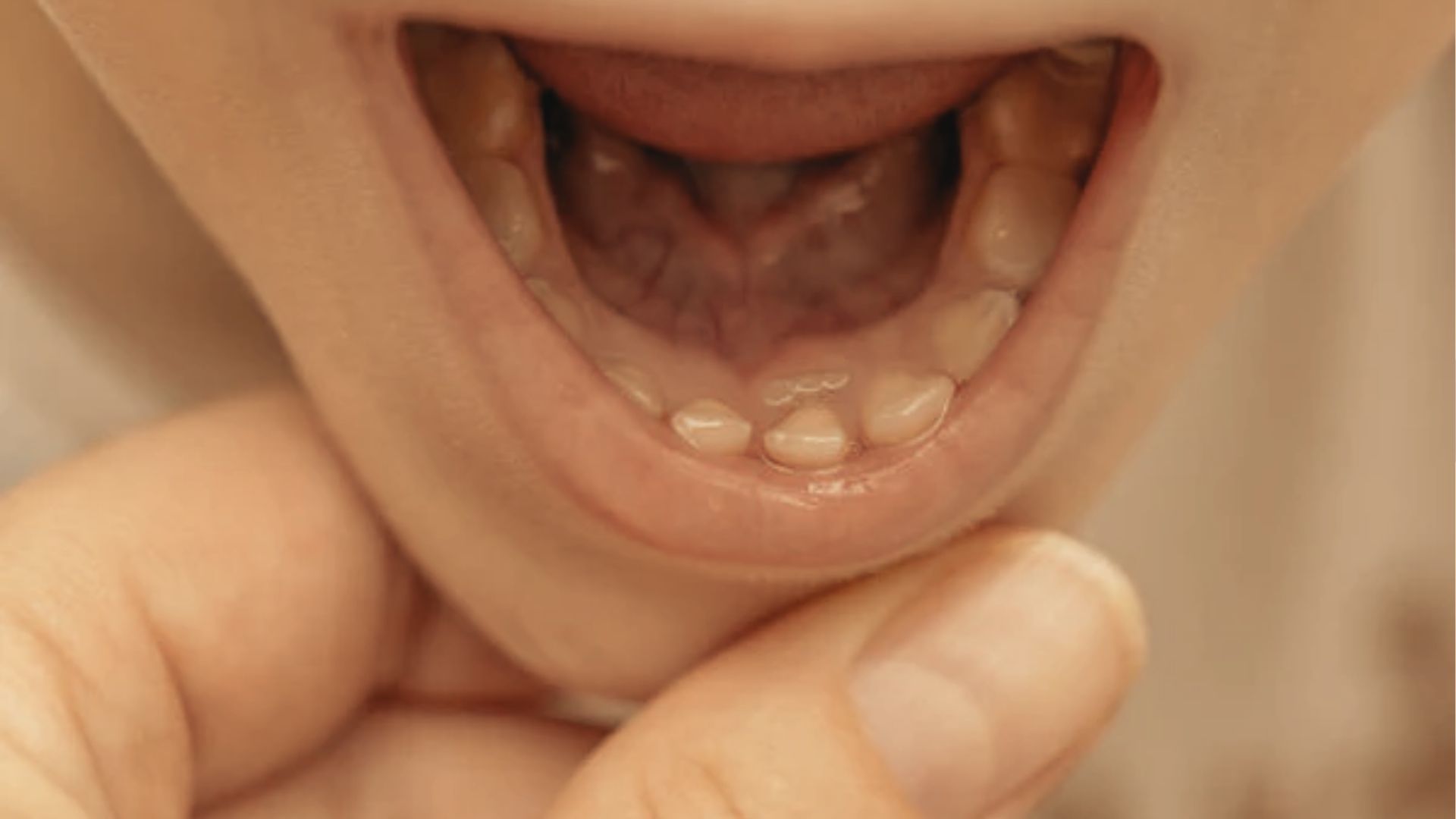 Baby’s open mouth held gently by an adult hand, revealing three small bottom teeth and several upper teeth coming in.